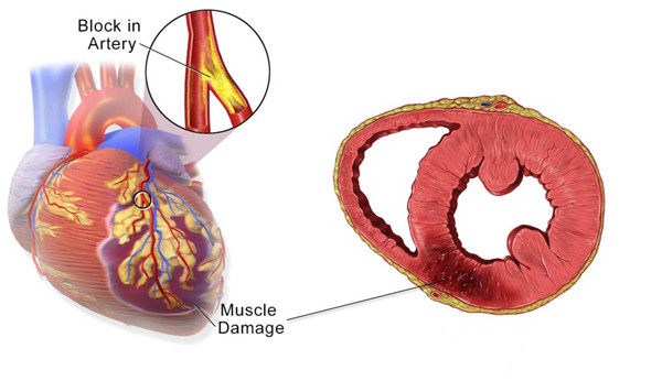 Cardiac Markers for Myocardial Infarction